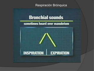 Respiración Brónquica
 