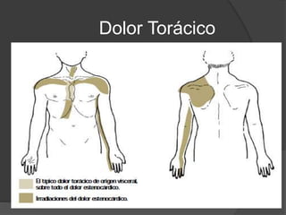 Dolor Torácico
 