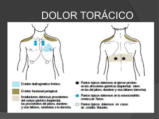 DOLOR TORÁCICO
 