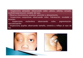- Inspecciona párpados observando color, ptosis, edema, orzuelo,
exoftalmia(protusion notable del ojo).
- Observa movimientos oculares; posición y alineamiento.
- Inspecciona conjuntivas observando color, hidratación, exudado y
lesiones.
- Inspecciona esclerótica observando color, pigmentación,
vascularización.
- Inspecciona pupilas observando tamaño, simetría y reflejo al rayo de
luz.
 