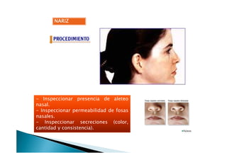 NARIZNARIZNARIZNARIZ
- Inspeccionar presencia de aleteo
nasal.
- Inspeccionar permeabilidad de fosas
nasales.
- Inspeccionar secreciones (color,
cantidad y consistencia).
 