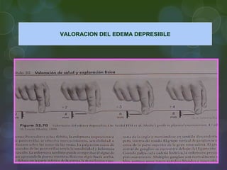 VALORACION DEL EDEMA DEPRESIBLE
 