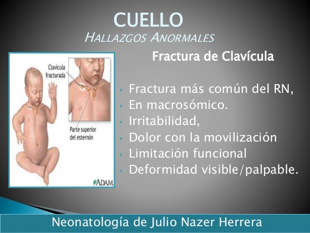 Hematoma Retrocorial Y Síndrome De Down
