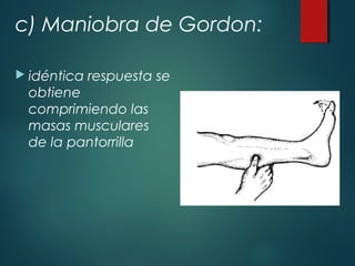 c) Maniobra de Gordon:
 idéntica respuesta se
obtiene
comprimiendo las
masas musculares
de la pantorrilla
 