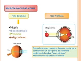 AGUDEZA O ACUIDAD VISUAL:

Falta de Nitidez

OJO NORMAL

•Miopía
•Hipermetropía
•Presbicia
•Astigmatismo

Rayos luminosos paralelos, llegan a la córnea y
confluyen en un solo punto de superficie
posterior de la retina “foco retiniano”.
Fenómeno de retracción es normal.

 