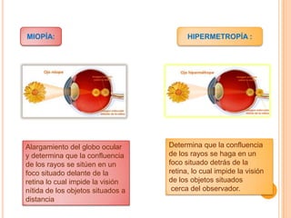 MIOPÍA:

Alargamiento del globo ocular
y determina que la confluencia
de los rayos se sitúen en un
foco situado delante de la
retina lo cual impide la visión
nítida de los objetos situados a
distancia

HIPERMETROPÍA :

Determina que la confluencia
de los rayos se haga en un
foco situado detrás de la
retina, lo cual impide la visión
de los objetos situados
cerca del observador.

 