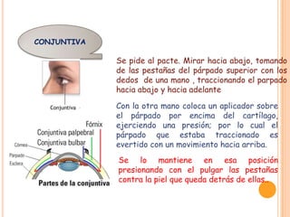 CONJUNTIVA

Se pide al pacte. Mirar hacia abajo, tomando
de las pestañas del párpado superior con los
dedos de una mano , traccionando el parpado
hacia abajo y hacia adelante
Con la otra mano coloca un aplicador sobre
el párpado por encima del cartílago,
ejerciendo una presión; por lo cual el
párpado que estaba traccionado es
evertido con un movimiento hacia arriba.
Se lo mantiene en esa posición
presionando con el pulgar las pestañas
contra la piel que queda detrás de ellas..

 