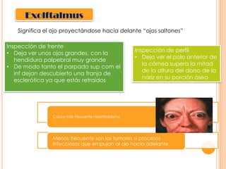 Exolftalmus
Significa el ojo proyectándose hacia delante “ojos saltones”
Inspección de frente
• Deja ver unos ojos grandes, con la
hendidura palpebral muy grande
• De modo tanto el parpado sup com el
inf dejan descubierto una franja de
esclerótica ya que estás retraídos

Inspección de perfil
• Deja ver el polo anterior de
la córnea supera la mitad
de la altura del dorso de la
nariz en su porción ósea

Causa más frecuente hipertiroidismo

Menos frecuente son los tumores o procesos
infecciosos que empujan al ojo hacia adelante

 