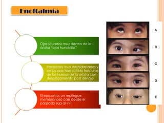 Enoftalmía

Ojos situados muy dentro de la
órbita “ojos hundidos”

Pacientes muy deshidratados y
en los que han sufrido fracturas
de los huesos de la órbita con
desplazamiento post del ojo

El epicanto: un repliegue
membranoso cae desde el
párpado sup al inf

 