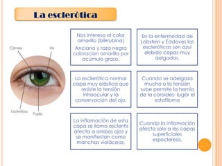 La esclerótica
Nos interesa el color
amarillo (bilirrubina)
Anciano y raza negra
coloracion amarilla por
acúmulo graso.

En la enfermedad de
Lobstein y Eddoves las
escleróticas son azul
debido capas muy
delgadas.

La esclerótica normal
capa muy elástica que
resiste la tensión
intraocular y la
conservación del ojo.

Cuando se adelgaza
mucho o la tensión
sube permite la hernia
de la coroides- lugar el
estafiloma

La inflamación de esta
capa se llama escleritis
afecta a ambos ojos y
se manifiestan como
manchas violáceas.

Cuandp la inflamación
afecta solo a las capas
superficiales
espiscleresis.

 