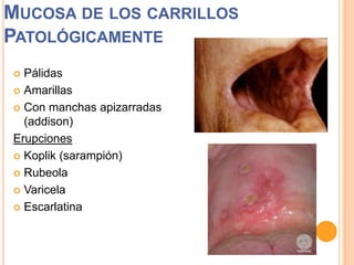 MUCOSA DE LOS CARRILLOS
PATOLÓGICAMENTE
Pálidas
 Amarillas
 Con manchas apizarradas
(addison)
Erupciones
 Koplik (sarampión)
 Rubeola
 Varicela
 Escarlatina


 