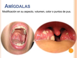 AMÍGDALAS
Modificación en su aspecto, volumen, color o puntos de pus.

 