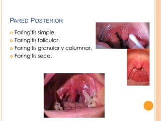 PARED POSTERIOR
Faringitis simple.
 Faringitis folicular.
 Faringitis granular y columnar.
 Faringitis seca.


 