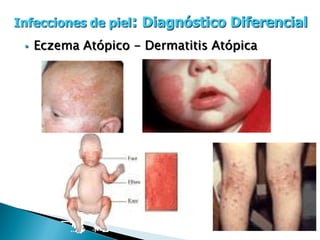 .
MICOTICAS
.
.
Infecciones de piel
 