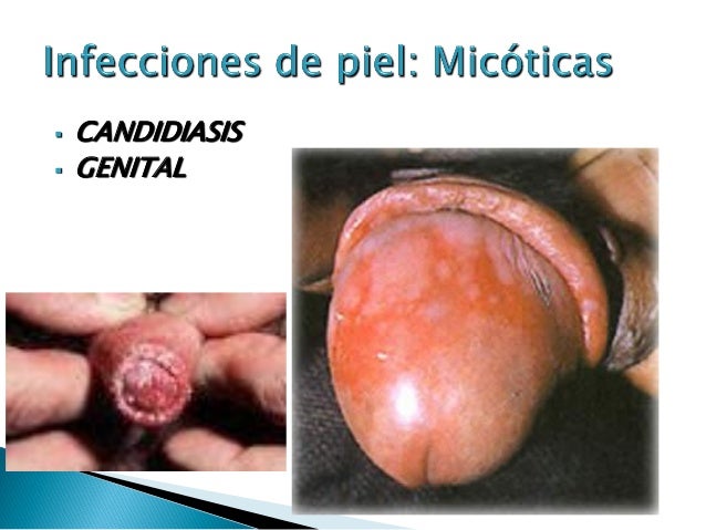 El tratamiento de la psoriasis los medicamentos