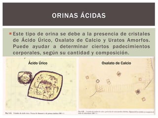  Este tipo de orina se debe a la presencia de cristales
de Ácido Úrico, Oxalato de Calcio y Uratos Amorfos.
Puede ayudar a determinar ciertos padecimientos
corporales, según su cantidad y composición.
ORINAS ÁCIDAS
Ácido Úrico Oxalato de Calcio
 