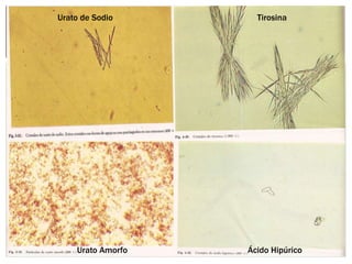 Urato de Sodio Tirosina
Ácido Hipúrico
Urato Amorfo
 