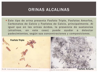  Este tipo de orina presenta Fosfato Triple, Fosfatos Amorfos,
Carbonatos de Calcio y Fosfatos de Calcio, principalmente. Al
igual que en las orinas ácidas, la presencia de sustancias
(alcalinas, en este caso) puede ayudar a detectar
padecimientos, según sus concentraciones y composiciones.
ORINAS ALCALINAS
Fosfato Triple
Fosfato Amorfo
 