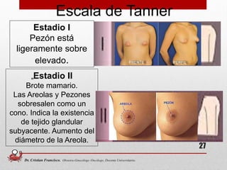 Estadio I
Pezón está
ligeramente sobre
elevado.
„Estadio II
Brote mamario.
Las Areolas y Pezones
sobresalen como un
cono. Indica la existencia
de tejido glandular
subyacente. Aumento del
diámetro de la Areola.
Escala de Tanner
27
Dr. Cristian Francisco. Obstetra-Ginecólogo /Oncólogo. Docente Universitario.
 