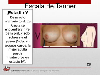„Estadio V
Desarrollo
mamario total. La
Areola se
encuentra a nivel
de la piel, y sólo
sobresale el
pezón (Nota: en
algunos casos, la
mujer adulta
puede
mantenerse en
estadio IV).
Escala de Tanner
29
Dr. Cristian Francisco. Obstetra-Ginecólogo /Oncólogo. Docente Universitario.
 
