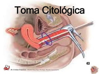 Toma Citológica
43
Dr. Cristian Francisco. Obstetra-Ginecólogo /Oncólogo. Docente Universitario.
 