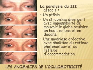 La paralysie du III
                associe :
              • Un ptôsis.
              • Un strabisme divergent
                avec impossibilité de
                mouvoir le globe oculaire
                en haut. en bas et en
                dedans.
              • Une mydriase aréactive,
                avec abolition du réflexe
                photomoteur et du
                réflexe
                d'accommodation.


LES ANOMALIES DE L’OCULOMOTRICITÉ
 