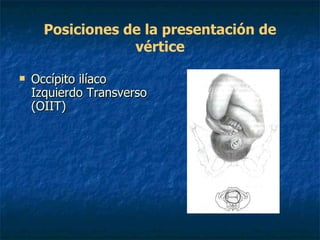 Posiciones de la presentación de vértice Occípito ilíaco Izquierdo Transverso (OIIT)   