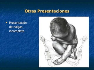 Otras Presentaciones Presentación  de nalgas  incompleta 