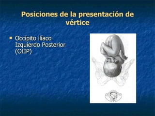 Posiciones de la presentación de vértice Occípito ilíaco Izquierdo Posterior (OIIP)   