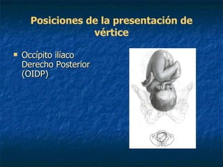 Posiciones de la presentación de vértice Occípito ilíaco Derecho Posterior (OIDP)   
