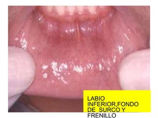 LABIO
INFERIOR,FONDO
DE SURCO Y
FRENILLO
 