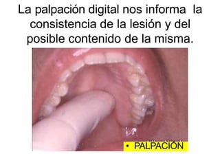 La palpación digital nos informa la
consistencia de la lesión y del
posible contenido de la misma.
• PALPACIÓN
 