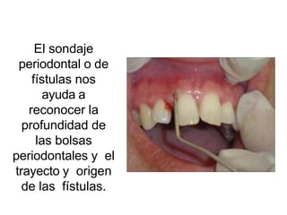 El sondaje
periodontal o de
fístulas nos
ayuda a
reconocer la
profundidad de
las bolsas
periodontales y el
trayecto y origen
de las fístulas.
 
