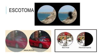 ESCOTOMA 
AMAUROSIS
 