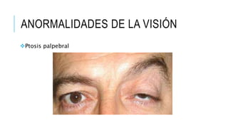 ANORMALIDADES DE LA VISIÓN
Ptosis palpebral
 