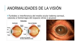 ANORMALIDADES DE LA VISIÓN
Turbidez o interferencia del medio ocular (edema corneal,
catarata o hemorragia del espacio vítreo o acuoso)
 