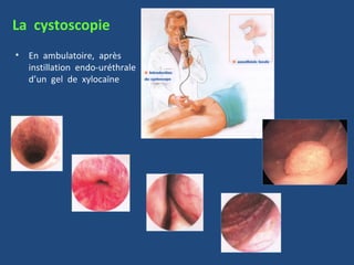 La cystoscopie
•   En ambulatoire, après
    instillation endo-uréthrale
    d’un gel de xylocaïne
 