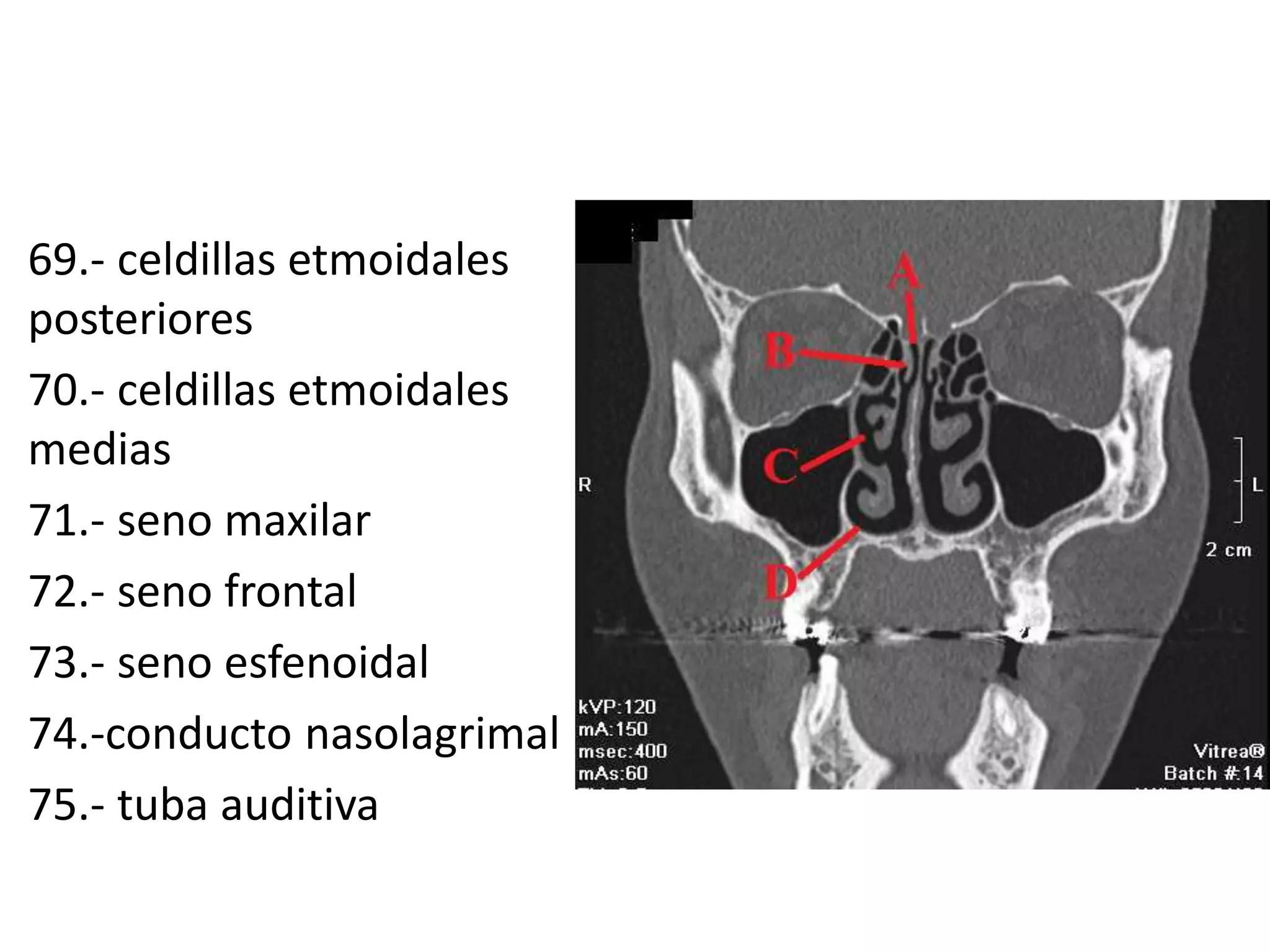 69.- celdillas etmoidales
posteriores
70.- celdillas etmoidales
medias
71.- seno maxilar
72.- seno frontal
73.- seno esfenoidal
74.-conducto nasolagrimal
75.- tuba auditiva
 