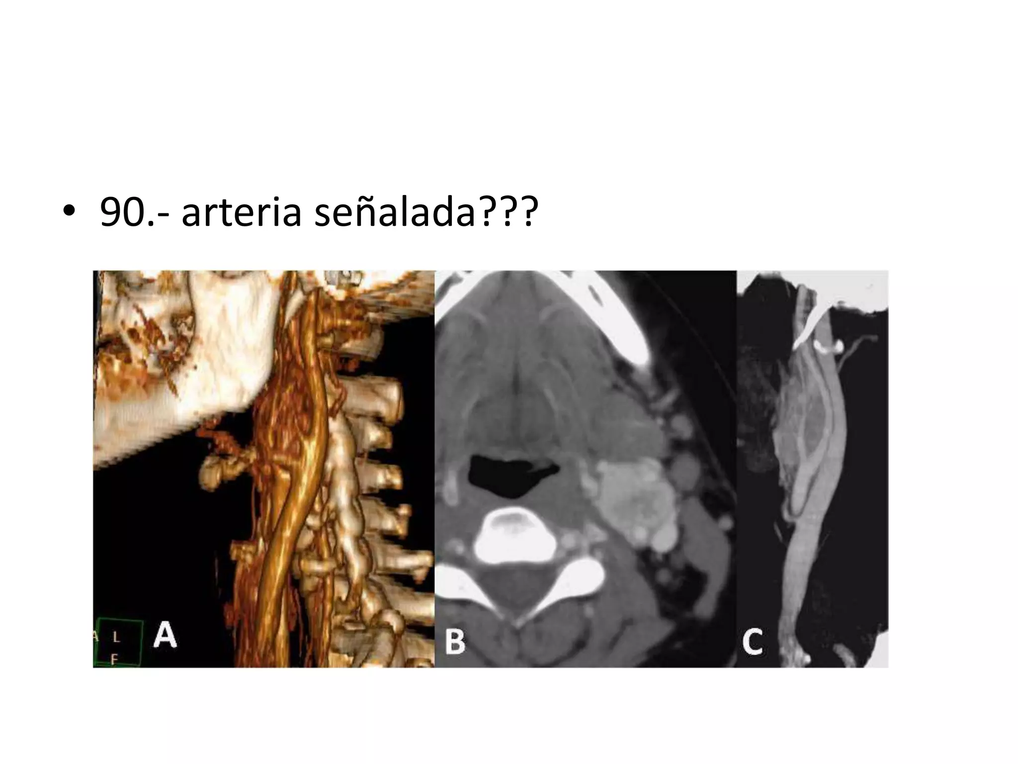 • 90.- arteria señalada???
 