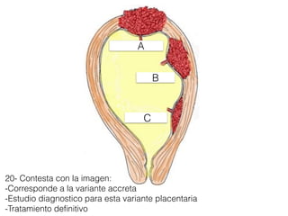 20- Contesta con la imagen:
-Corresponde a la variante accreta
-Estudio diagnostico para esta variante placentaria
-Tratamiento deﬁnitivo
A
C
B
 
