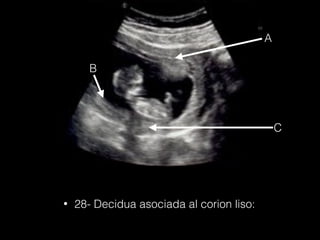 A
B
C
• 28- Decidua asociada al corion liso:
 