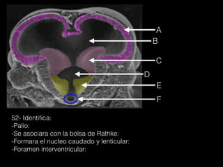 52- Identiﬁca:
-Palio:
-Se asociara con la bolsa de Rathke:
-Formara el nucleo caudado y lenticular:
-Foramen interventricular:
A
B
C
D
E
F
 
