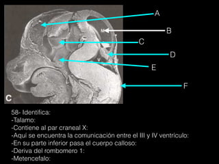 E
C
B
F
D
A
58- Identiﬁca:
-Talamo:
-Contiene al par craneal X:
-Aquí se encuentra la comunicación entre el III y IV ventrículo:
-En su parte inferior pasa el cuerpo calloso:
-Deriva del rombomero 1:
-Metencefalo:
 
