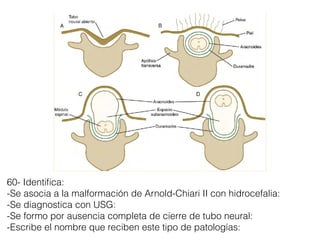 60- Identiﬁca:
-Se asocia a la malformación de Arnold-Chiari II con hidrocefalia:
-Se diagnostica con USG:
-Se formo por ausencia completa de cierre de tubo neural:
-Escribe el nombre que reciben este tipo de patologías:
 