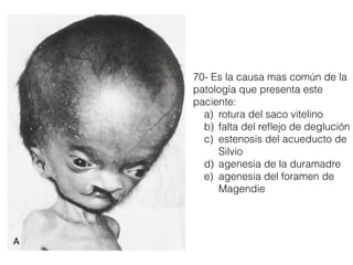 70- Es la causa mas común de la
patología que presenta este
paciente:
a) rotura del saco vitelino
b) falta del reﬂejo de deglución
c) estenosis del acueducto de
Silvio
d) agenesia de la duramadre
e) agenesia del foramen de
Magendie
 
