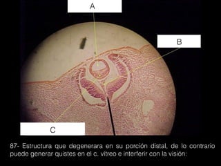 87- Estructura que degenerara en su porción distal, de lo contrario
puede generar quistes en el c. vítreo e interferir con la visión:
A
B
C
 