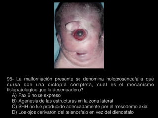 95- La malformación presente se denomina holoprosencefalia que
cursa con una ciclopía completa, cual es el mecanismo
ﬁsiopatologico que lo desencadeno?:
A) Pax 6 no se expreso
B) Agenesia de las estructuras en la zona lateral
C) SHH no fue producido adecuadamente por el mesodemo axial
D) Los ojos derivaron del telencefalo en vez del diencefalo
 