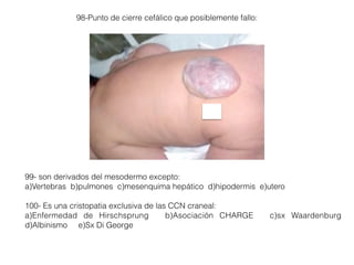 98-Punto de cierre cefálico que posiblemente fallo:
99- son derivados del mesodermo excepto:
a)Vertebras b)pulmones c)mesenquima hepático d)hipodermis e)utero
100- Es una cristopatia exclusiva de las CCN craneal:
a)Enfermedad de Hirschsprung b)Asociación CHARGE c)sx Waardenburg
d)Albinismo e)Sx Di George
 