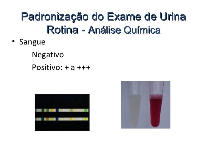 Exame urina leucocitos