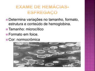  Determina variações no tamanho, formato,
estrutura e conteúdo de hemoglobina.
 Tamanho: microcítico
 Formato em foice.
 Cor: normocrômica
 